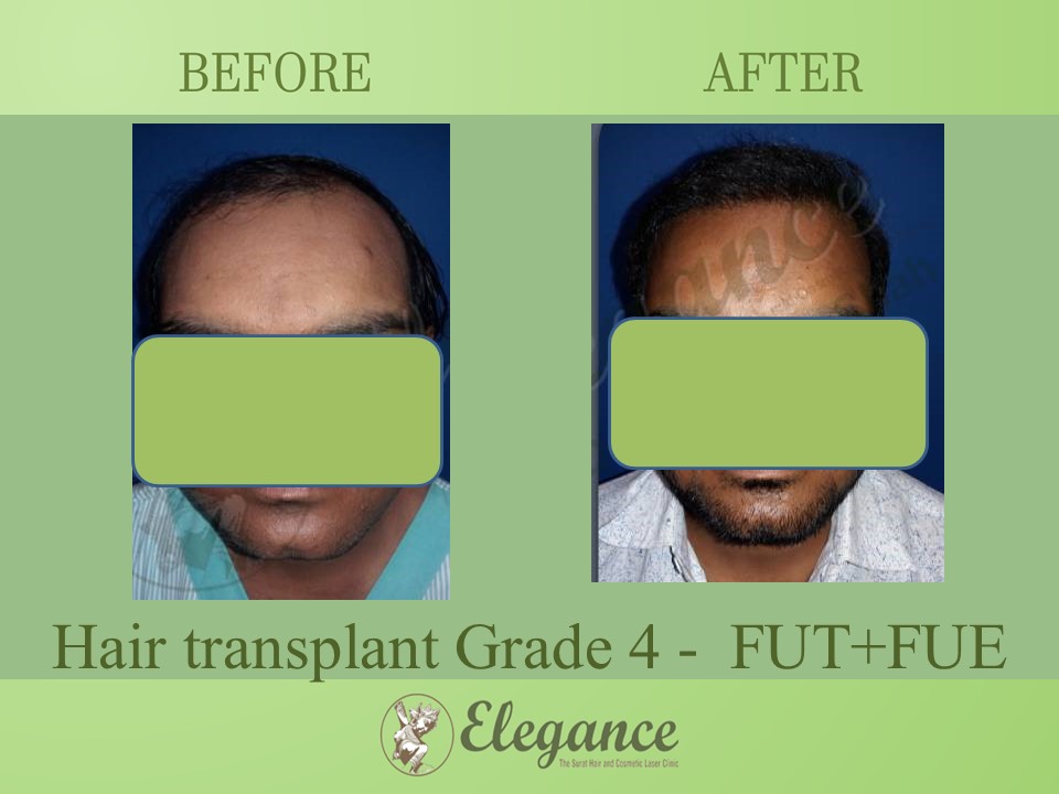 Cost Hair Transplant In Jamnagar, Gujarat, India
