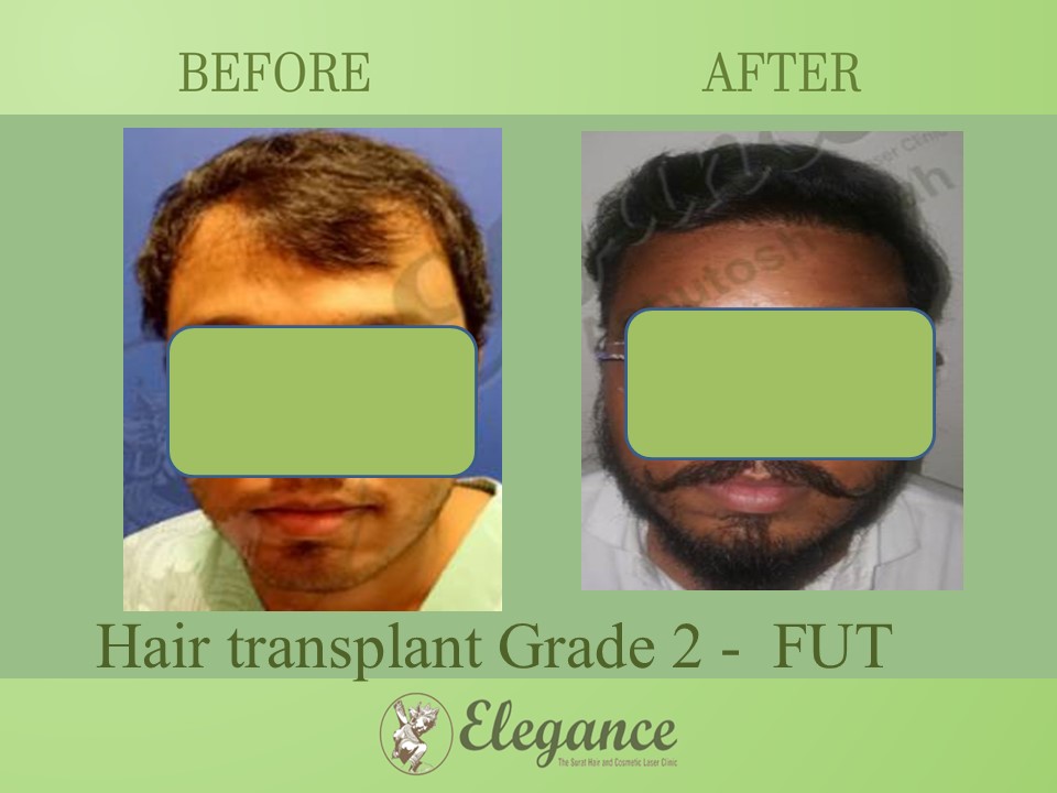 Cost Hair Transplant In Junagadh, Gujarat, India