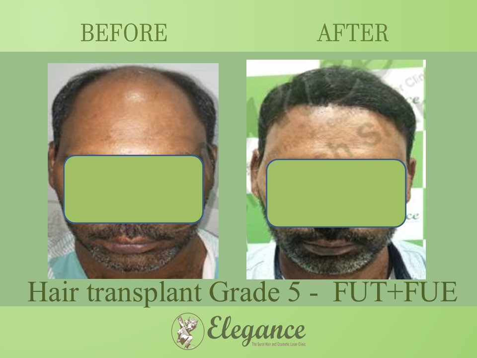 Cost Hair Transplant In Latur, Maharashtra, India