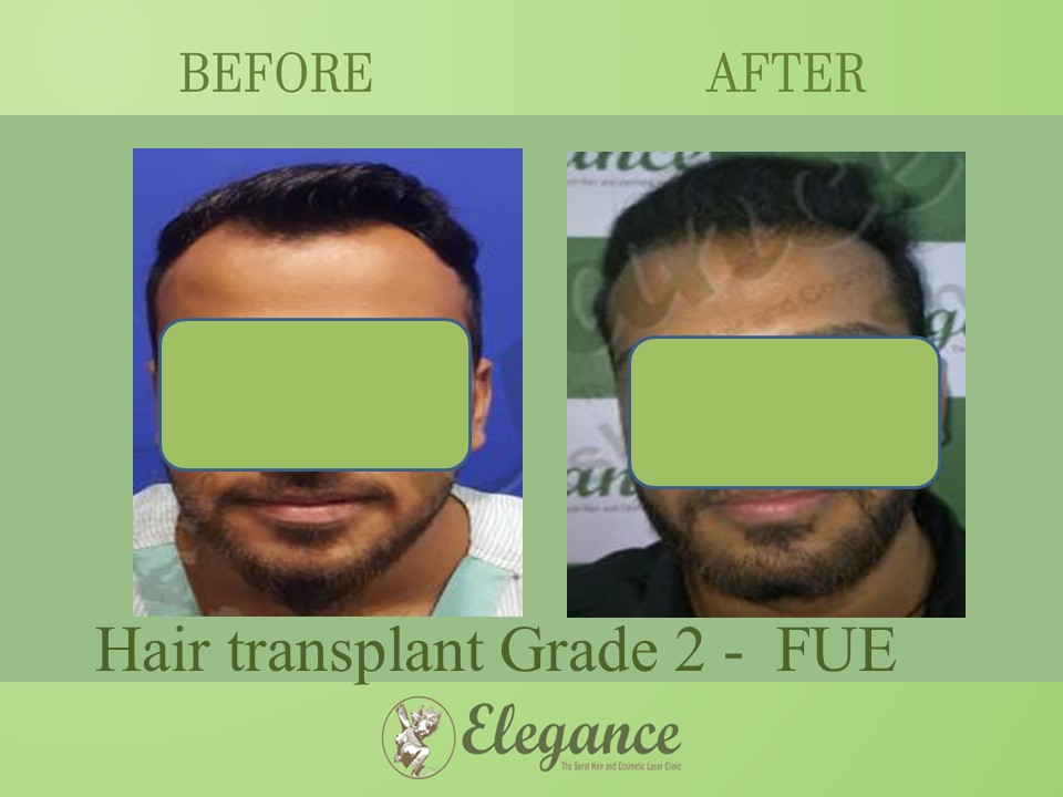 Cost Hair Transplant In Madhya Pradesh, India