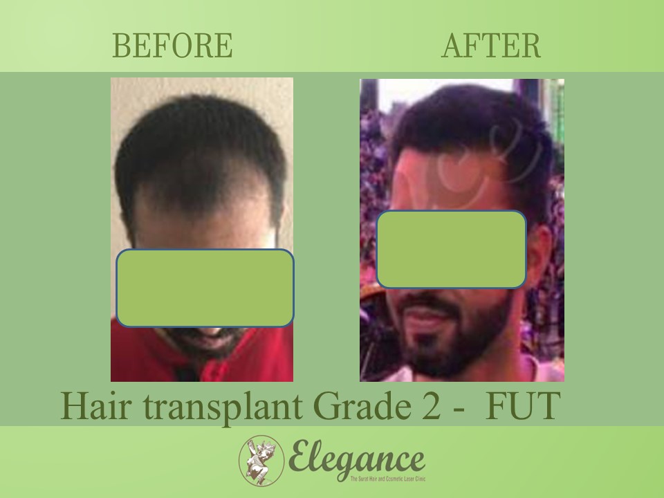Cost Hair Transplant In Nashik, Maharashtra, India