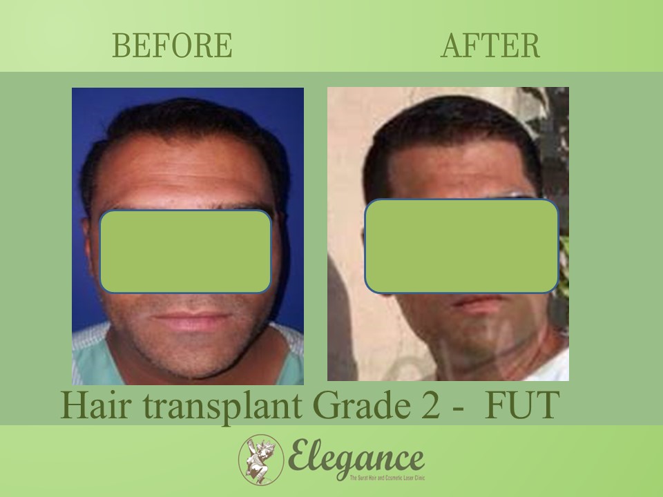 Cost Hair Transplant In Panchmahal, Gujarat, India