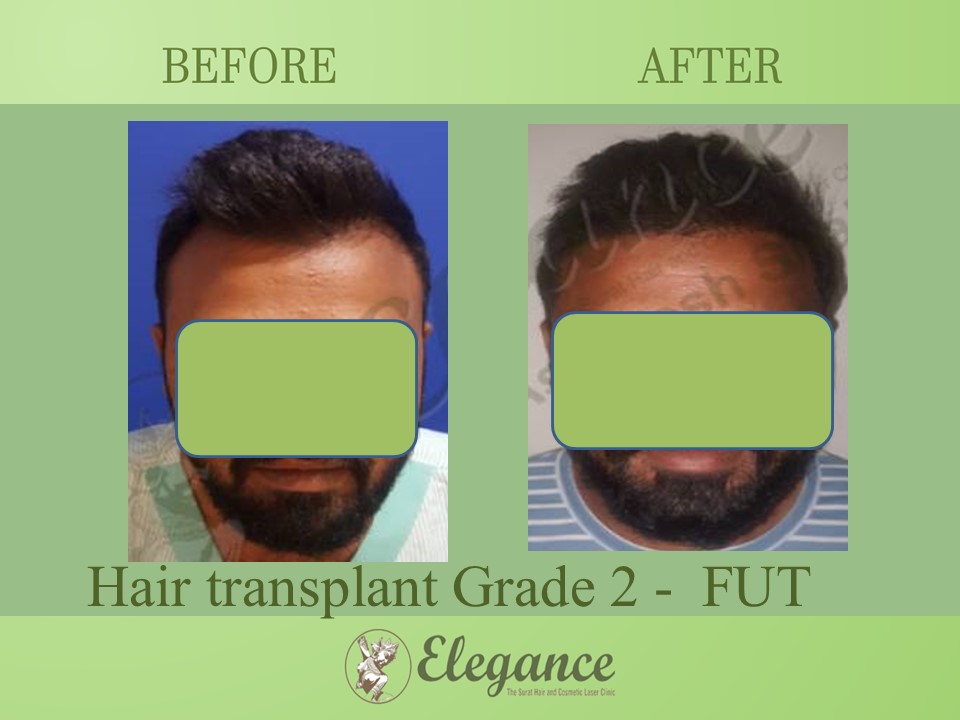 Cost Hair Transplant In Porbandar, Gujarat, India