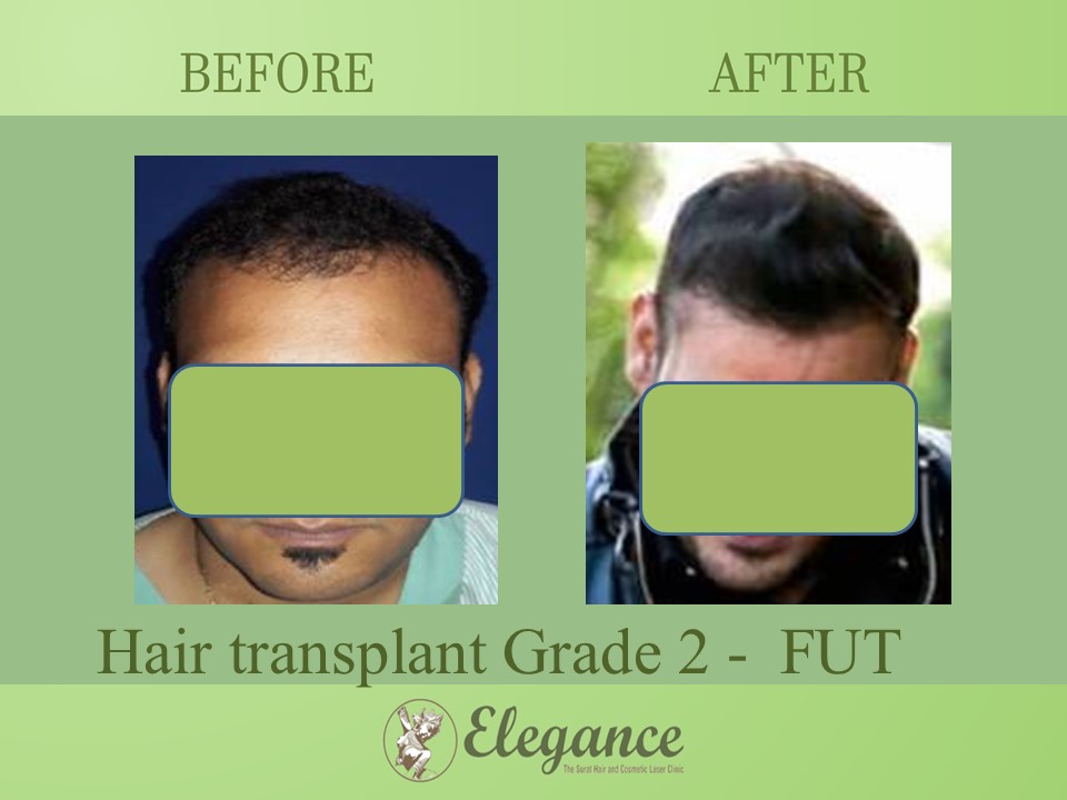 Cost Hair Transplant In Rajasthan, India