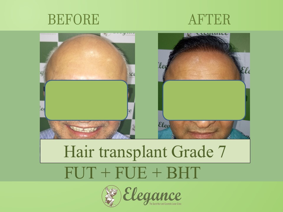 Cost Hair Transplant In Sikar, Rajasthan, India