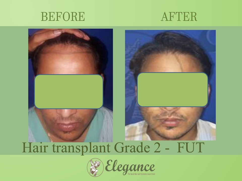 Cost Hair Transplant In Vapi, Gujarat, India