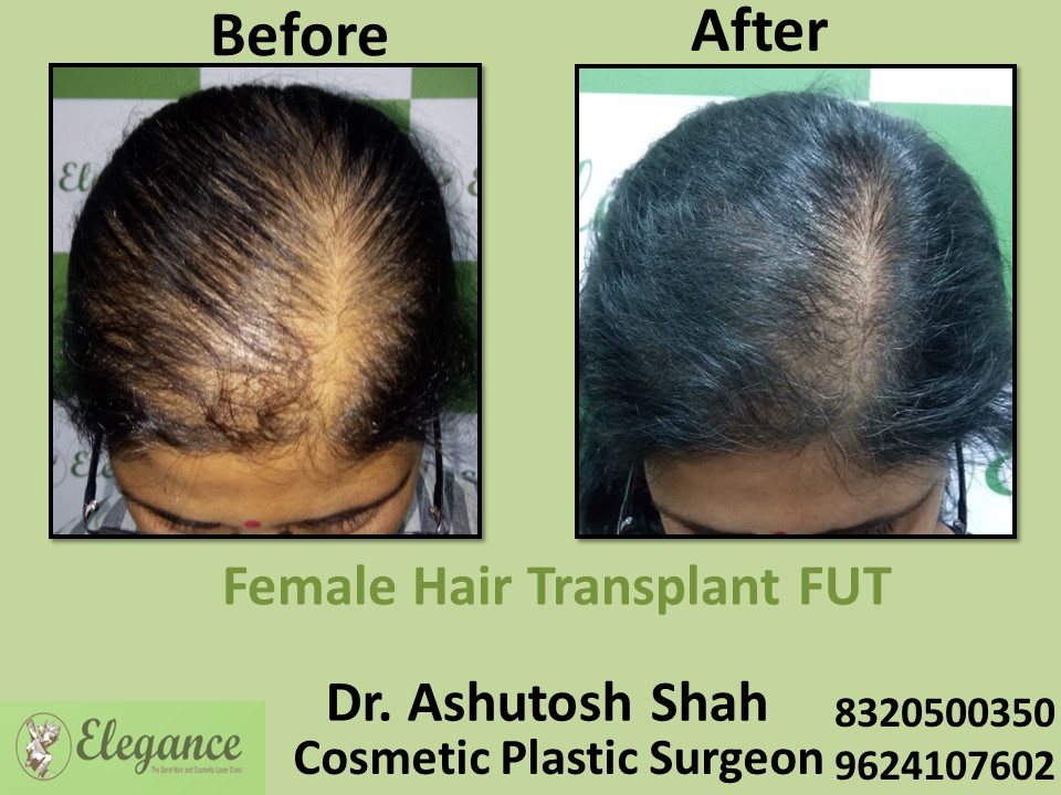 Female Hair Transplant, Hair Regrow Treatment in Piplod, Surat