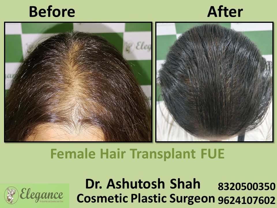 Female Hair Transplant, Hair Regrow Treatment, FUT  in Surat
