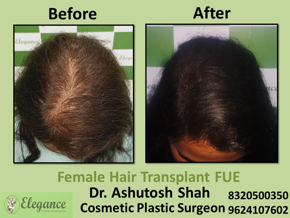 Female Hair Transplant, FUT Method, Hair Regrow Treatment in Udhna, Surat