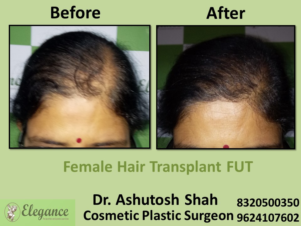 Female Hair Transplant, Hair Regrow Treatment, FUT, in Vesu, Athwagate, Surat
