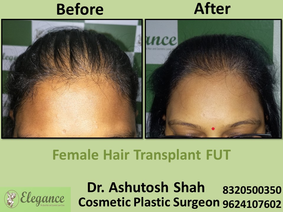 Female Hair Transplant, FUT Hair Regrow Treatment in Vesu, Piplod, Surat