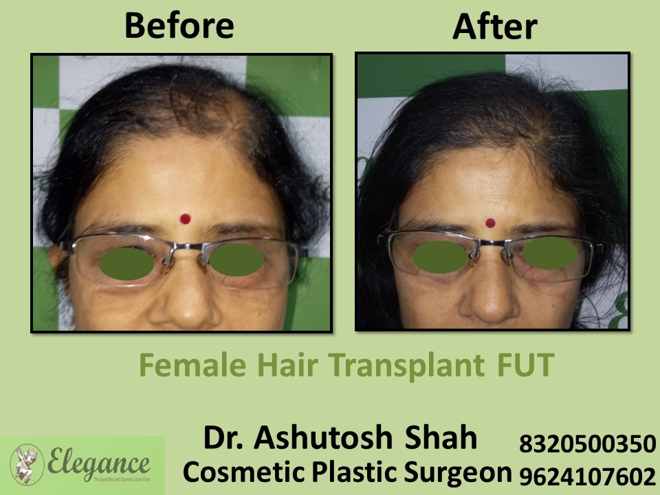 Female Hair Transplant, Hair Regrow Treatment, FUT in Vesu, Surat