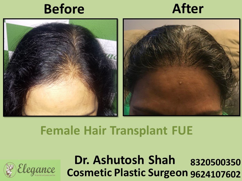 Female Hair Transplant, Hair Regrow, FUT Treatment in Vesu