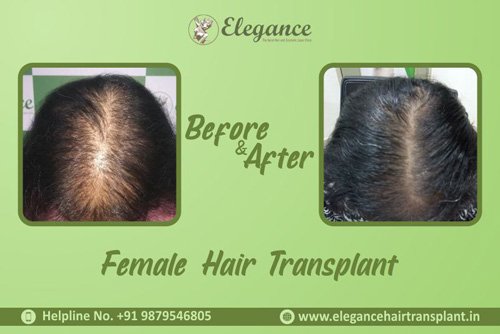 Female Hair Transplant  in Surat, Gujarat, india