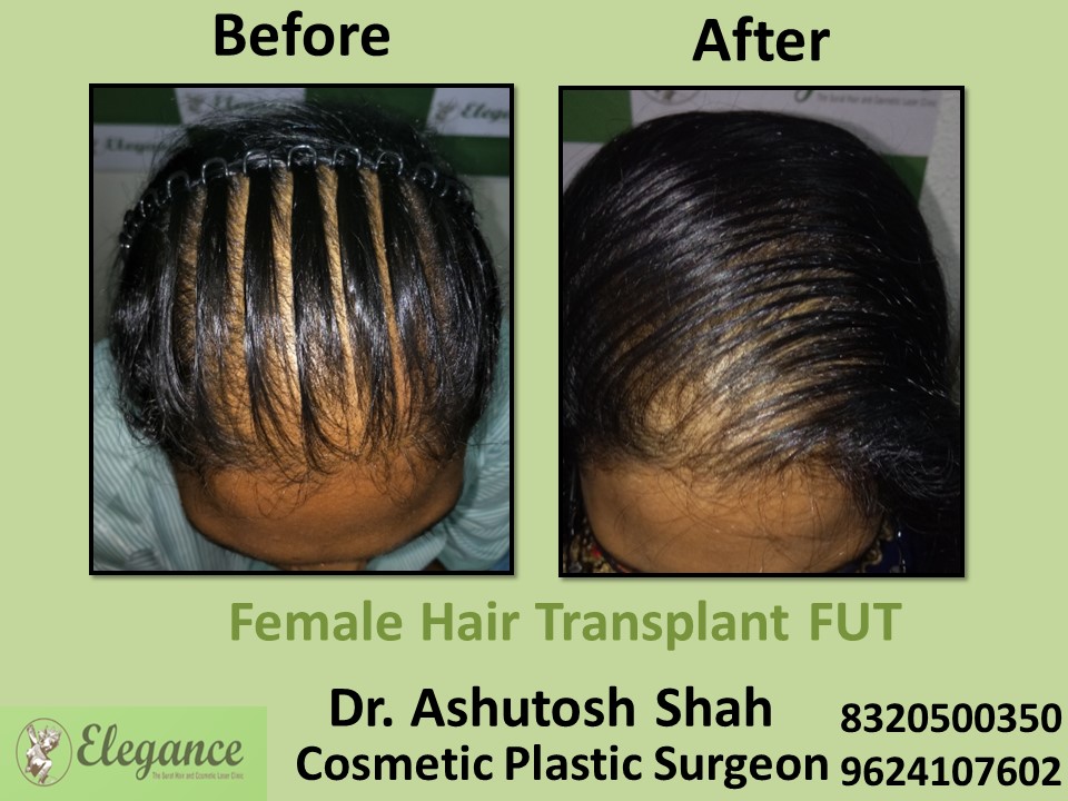 Hair Regrow, Hair Baldness in Vesu, Surat