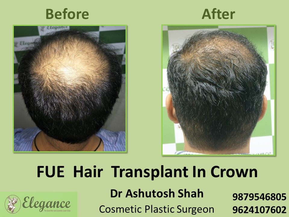 FUE Hair Transplant in Crown in Adajan, Surat