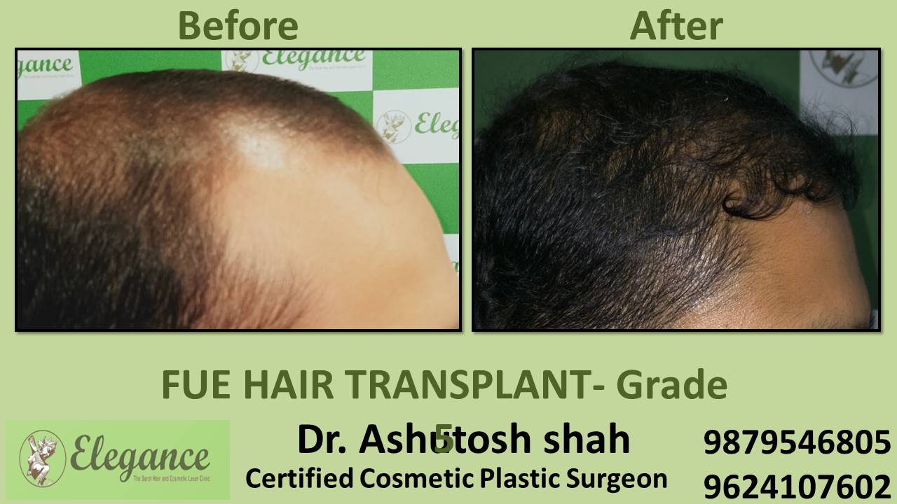 FUE Hair Transplant in Surat Gujarat