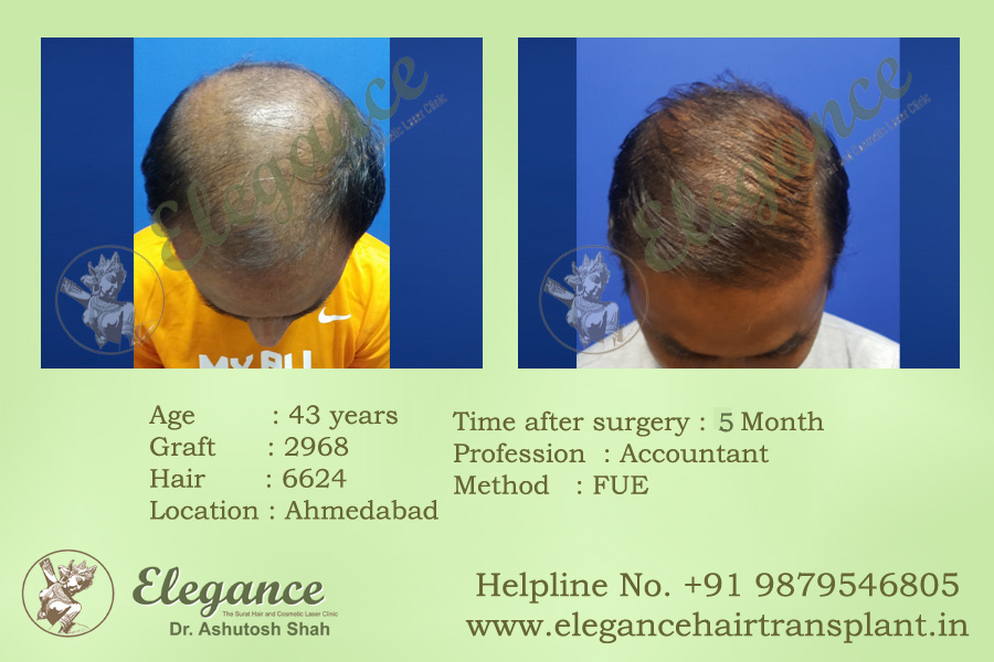 Best Fue Hair Transplant Surat, Gujarat, india