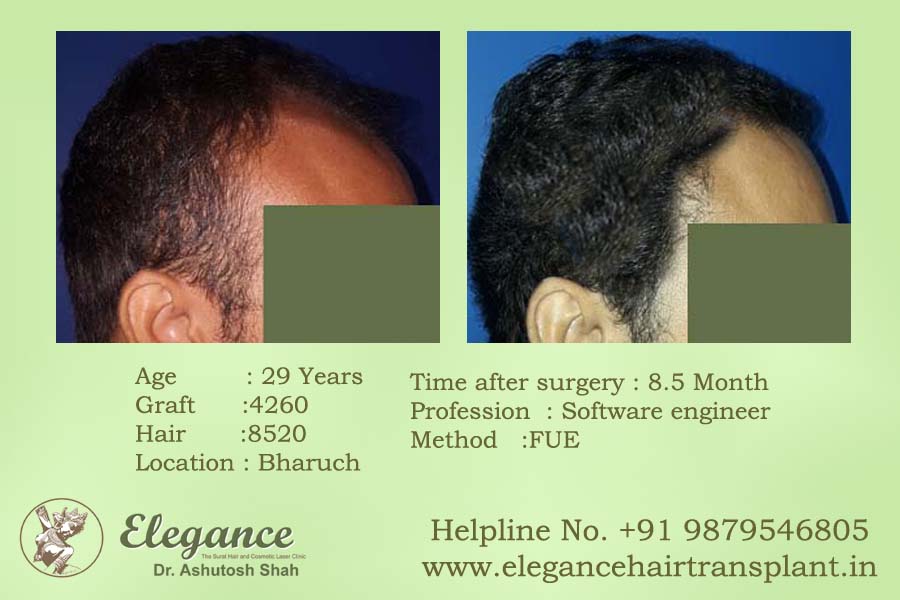 Best Hair Transplant Doctor in Surat, Gujarat, india