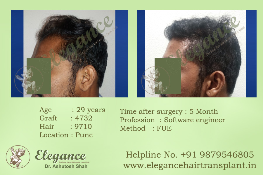 Best Hair Transplant Surgery in Vapi, Gujarat, india