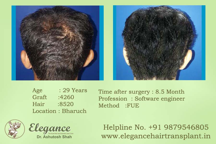 Best Hair Transplant in Surat, Gujarat, india
