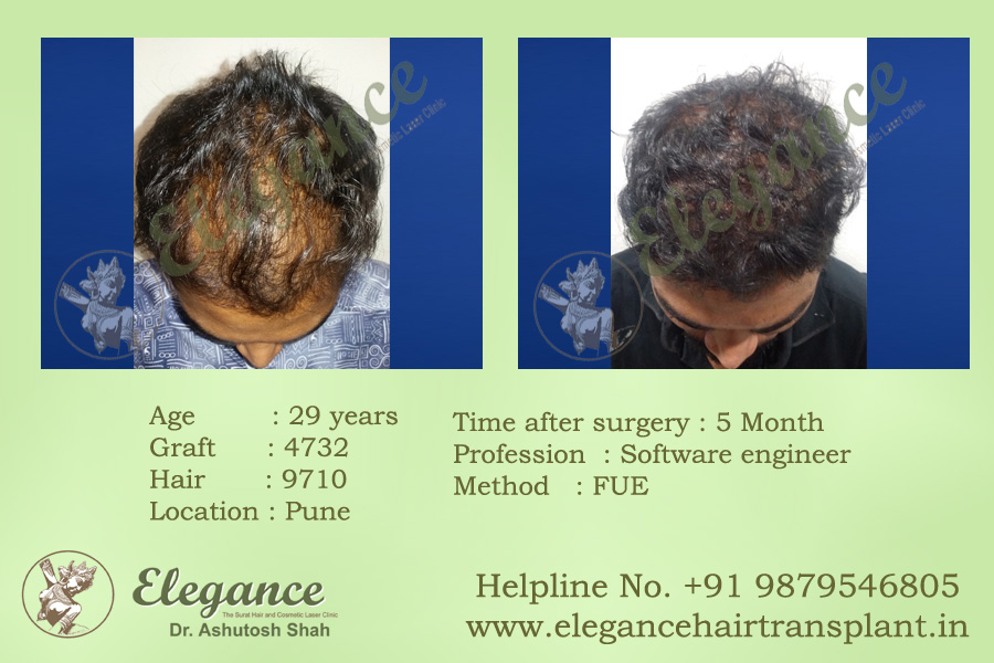 Hair Transplant Treatment in Vapi, Gujarat, india