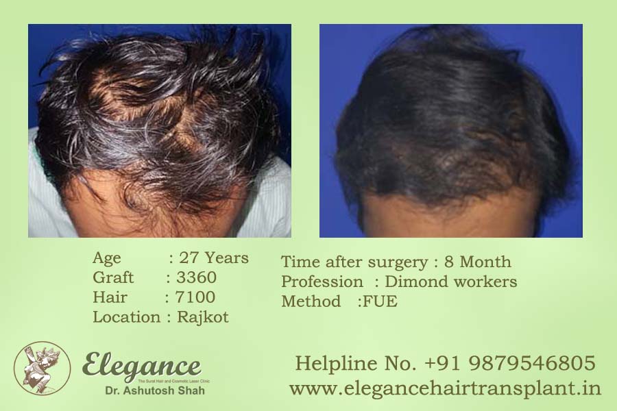 Fue Hair Transplant Before and After Surat, Gujarat, india
