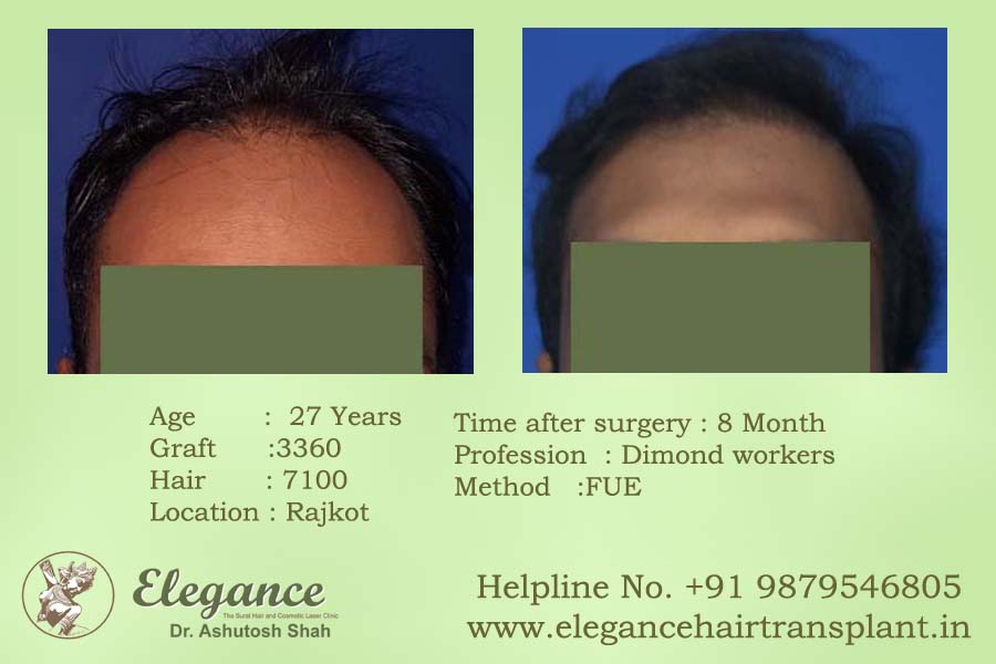 Fue Hair Transplant Cost Surat, Gujarat, india