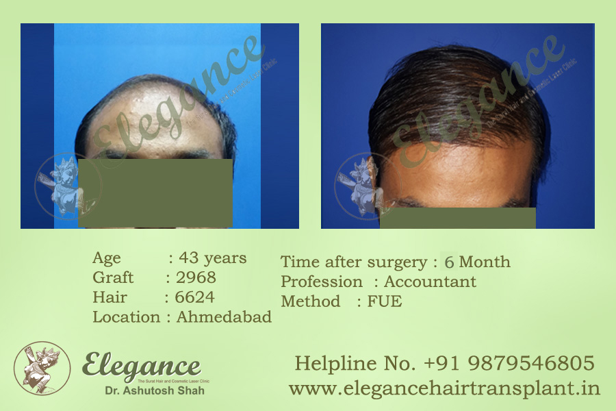 Hair Transplant procedure Vapi, Gujarat, india