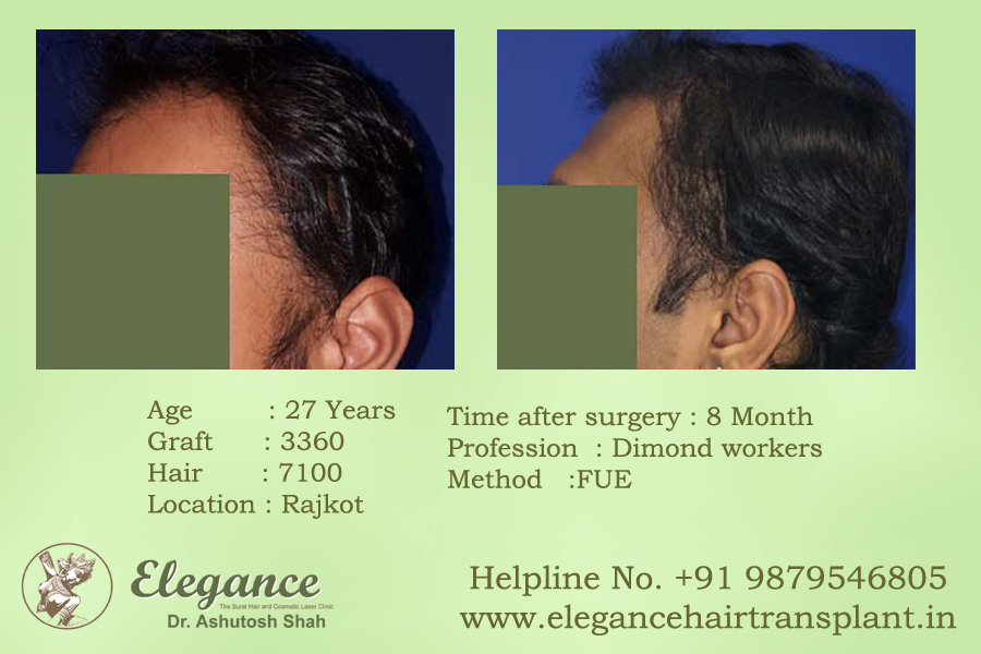 Fue Hair Transplant Results Surat, Gujarat, india