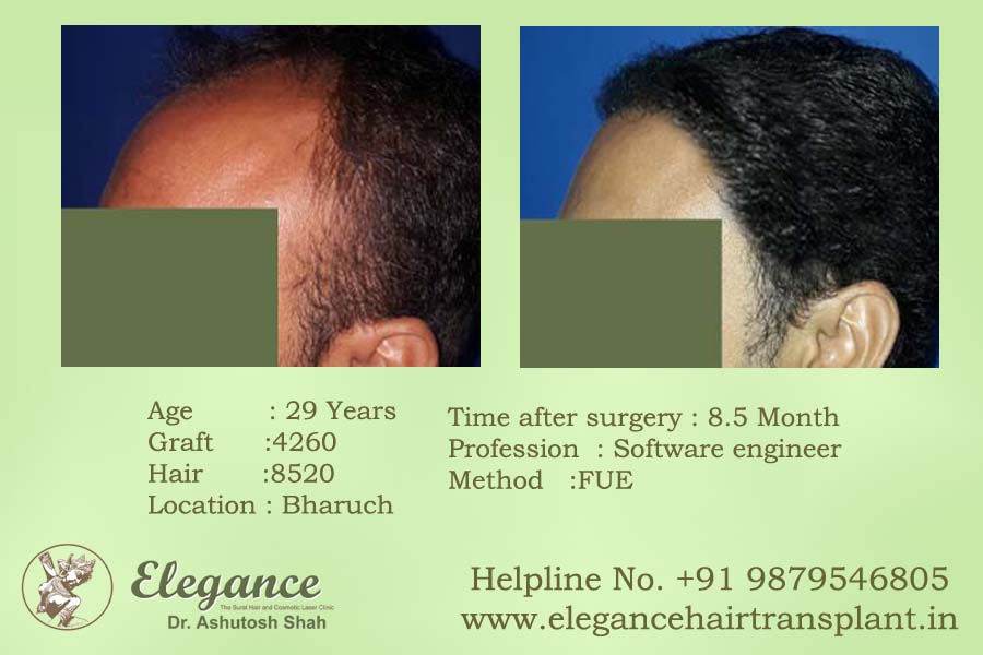 Hair Clinic in Surat, Gujarat, india