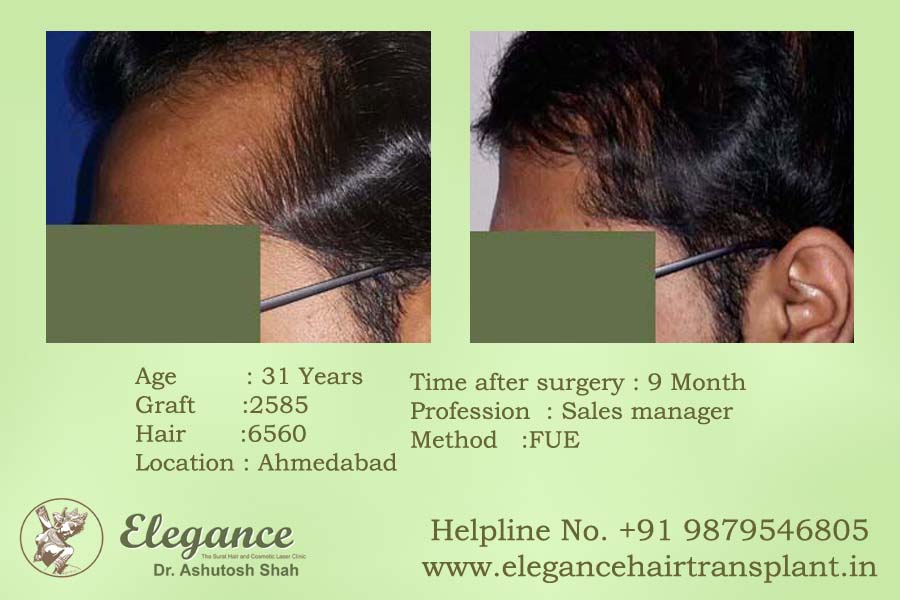 Hair Replacement in Surat, Gujarat, india