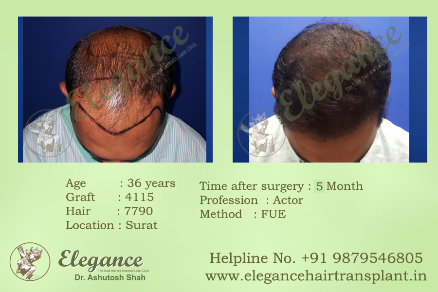 Hair Replacement in Vapi, Gujarat, india