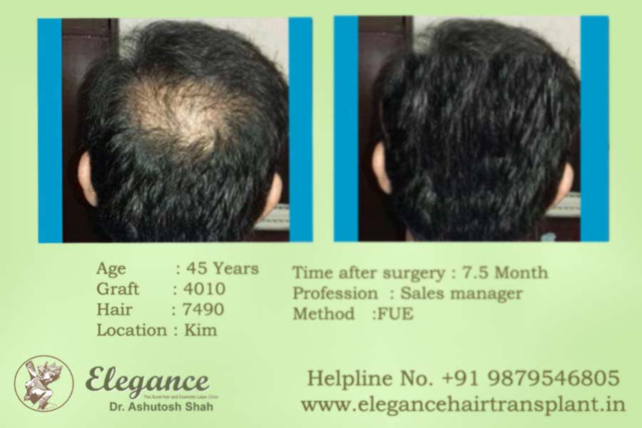 Hair Transplant Clinic in Surat, Gujarat, india