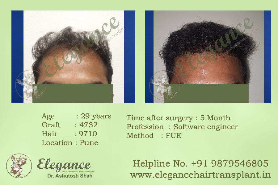 Clinic Hair Transplant in Vapi, Gujarat, india