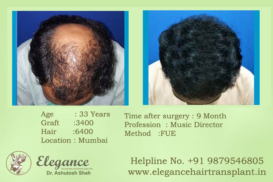 Hair Transplant Cost in Surat, Gujarat, india