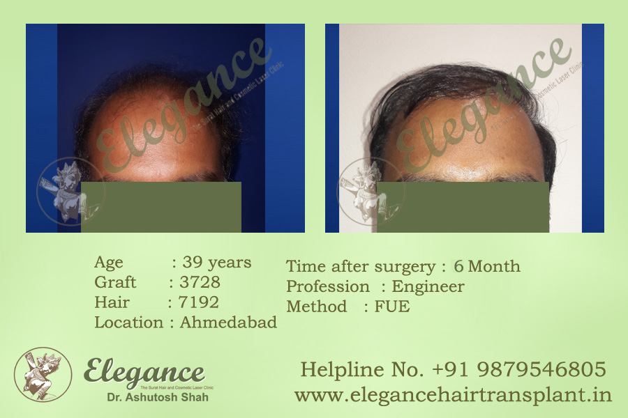 Hair Transplant Surgery Cost in Vapi, Gujarat, india