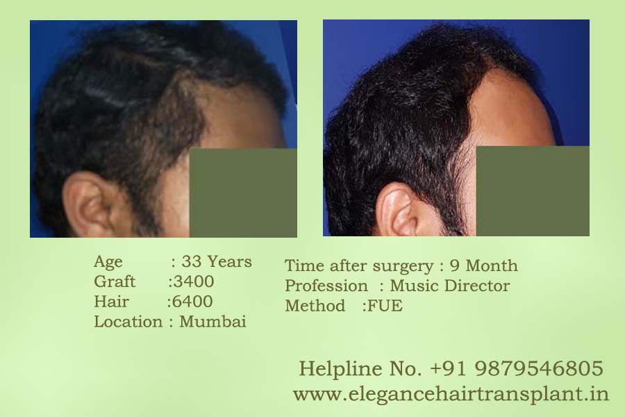 Hair Transplant in Surat Price