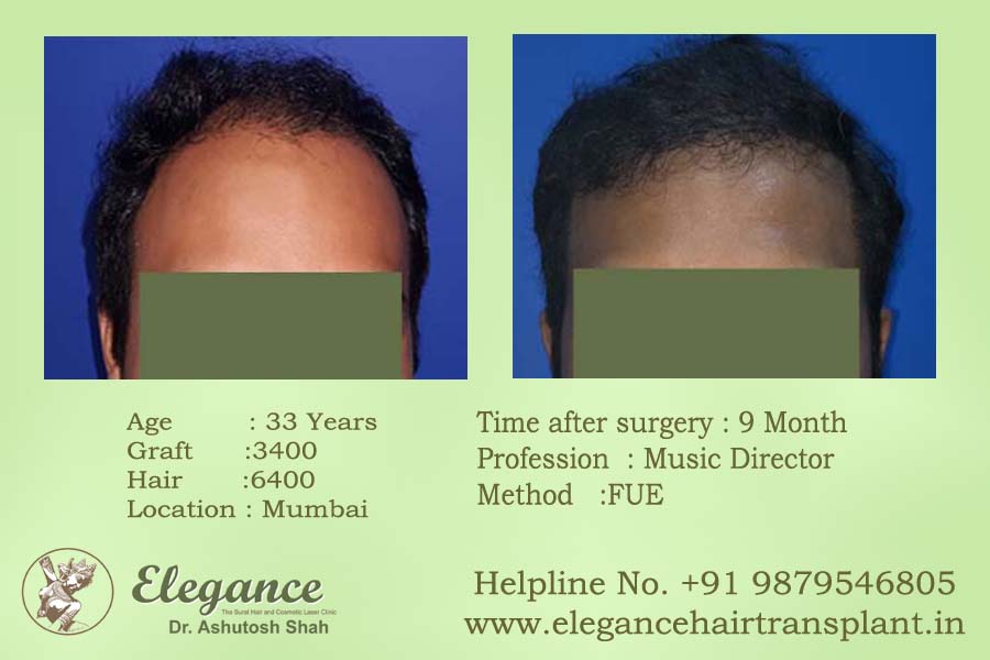 Hair Transplant in Surat, Gujarat, india