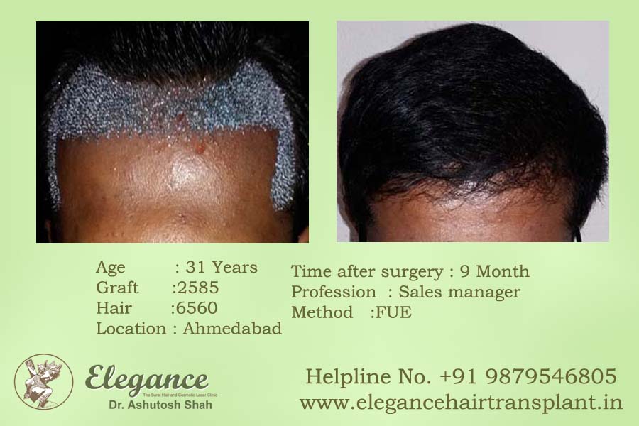 Surat, Gujarat, india Hair Transplant Clinic