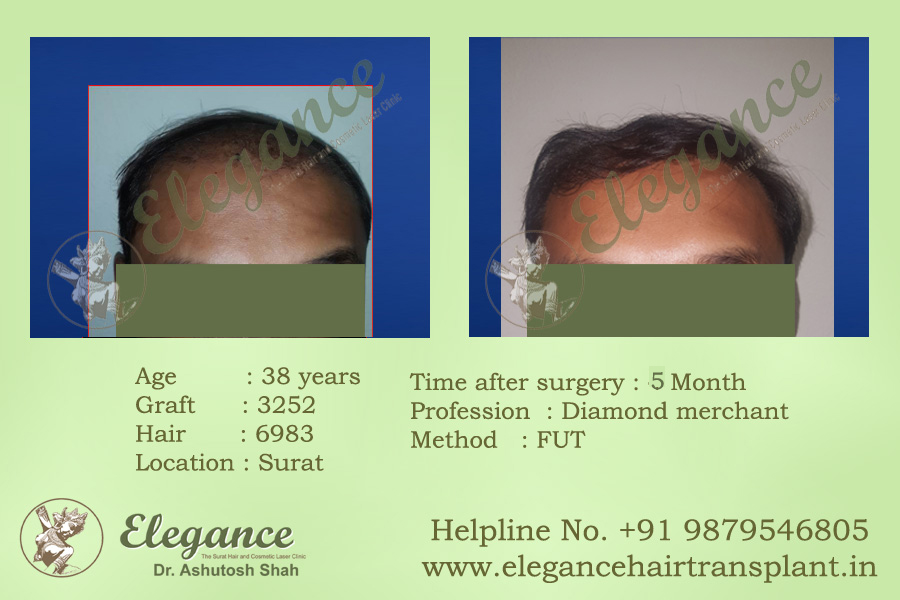 Ankleswar, Gujarat, india Hair Transplant Clinic