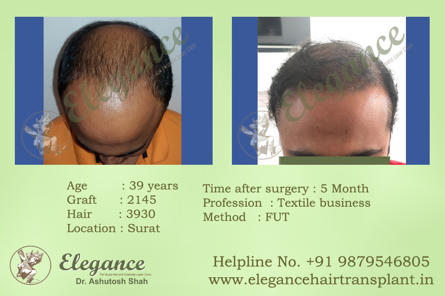 Best FUT Hair Transplant Valsad, Gujarat, india