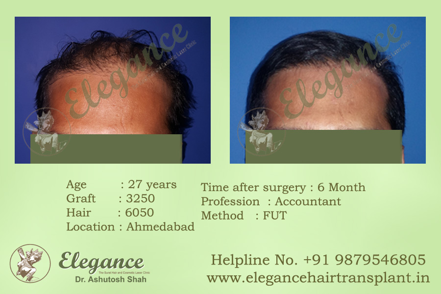 Best FUT Hair Transplant Vapi, Gujarat, india