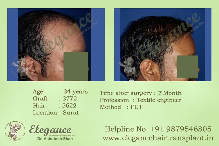Best Hair Transplant Clinic in Valsad, Gujarat, india