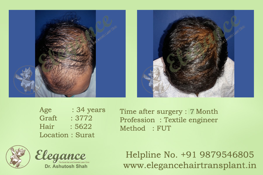 Best Hair Transplant Doctor in Valsad, Gujarat, india