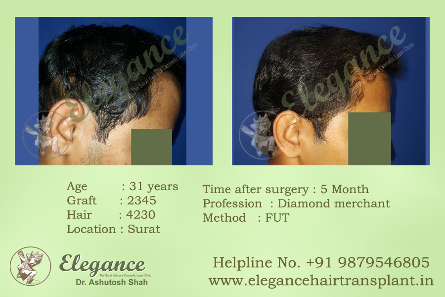 Best Hair Transplant in Ankleshwar, Gujarat, india