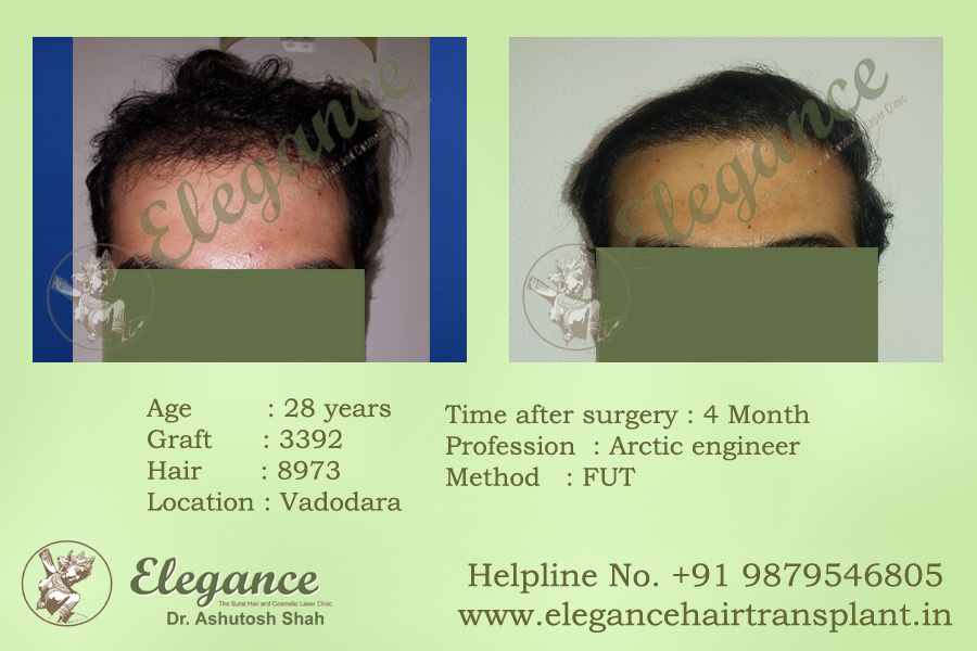 FUT Hair Transplant Before and After Ankleswar, Gujarat, india