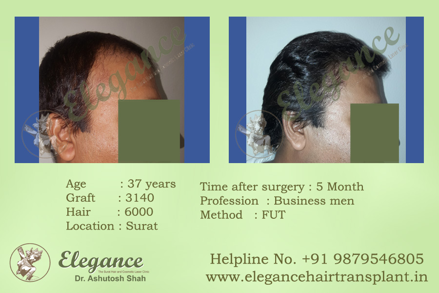 FUT Hair Transplant Before and After Valsad, Gujarat, india