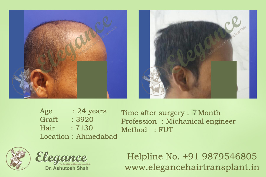 FUT Hair Transplant Before and After Vapi, Gujarat, india