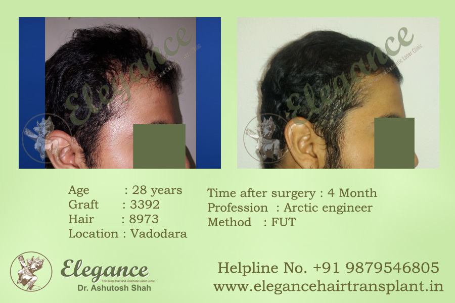 FUT Hair Transplant Cost Ankleswar, Gujarat, india